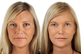 Photo 2-before and after application of Goji Cream