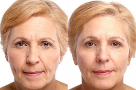 Photo 3 before and after the application of Cream Goji