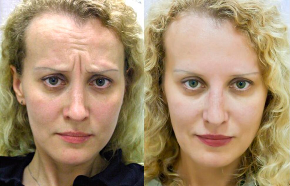 before and after using massage tools for rejuvenation ltza photo 1