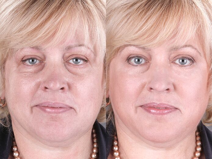 before and after using massage tools for rejuvenation ltza photo 3