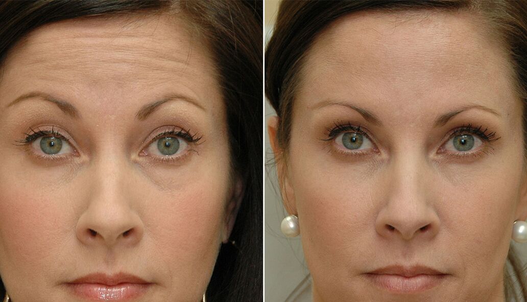 before and after using massage tools for rejuvenation ltza photo 4