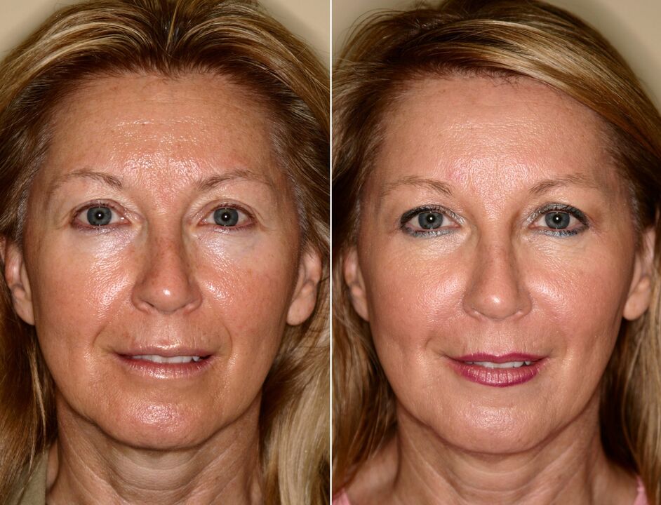 before and after using massage tools for rejuvenation ltza photo 5