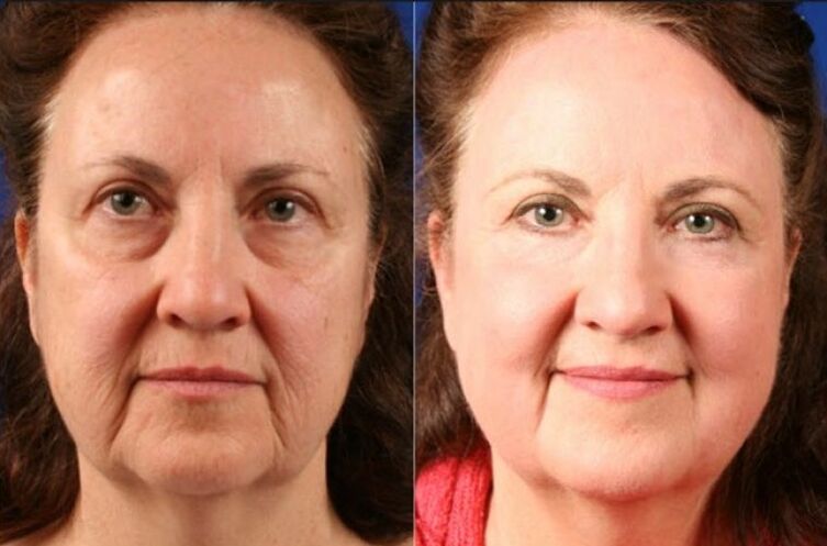 before and after using massage tools for rejuvenation ltza photo 6