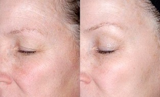 skin rejuvenation around the eyes before and after pictures