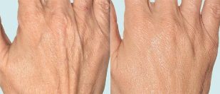 Hand skin before and after fracture therapy