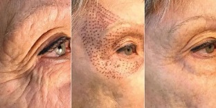 pictures before and after plasma skin rejuvenation